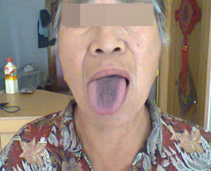 舌苔发黑 胃病的先兆